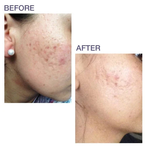 Pro-Sil Silicone Stick for Scars