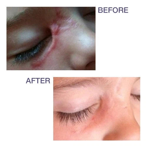 Pro-Sil Silicone Stick for Scars